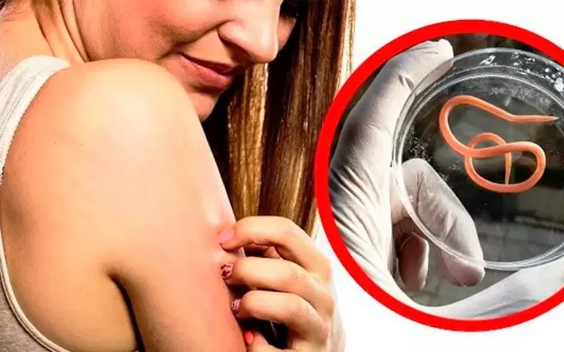 tanadagi parazitlar tufayli qichishish va tirnash xususiyati